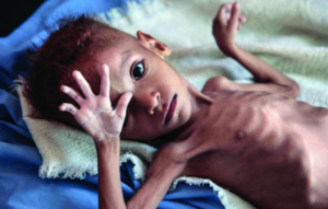 Poverty-Hunger In India: malnutrition in India