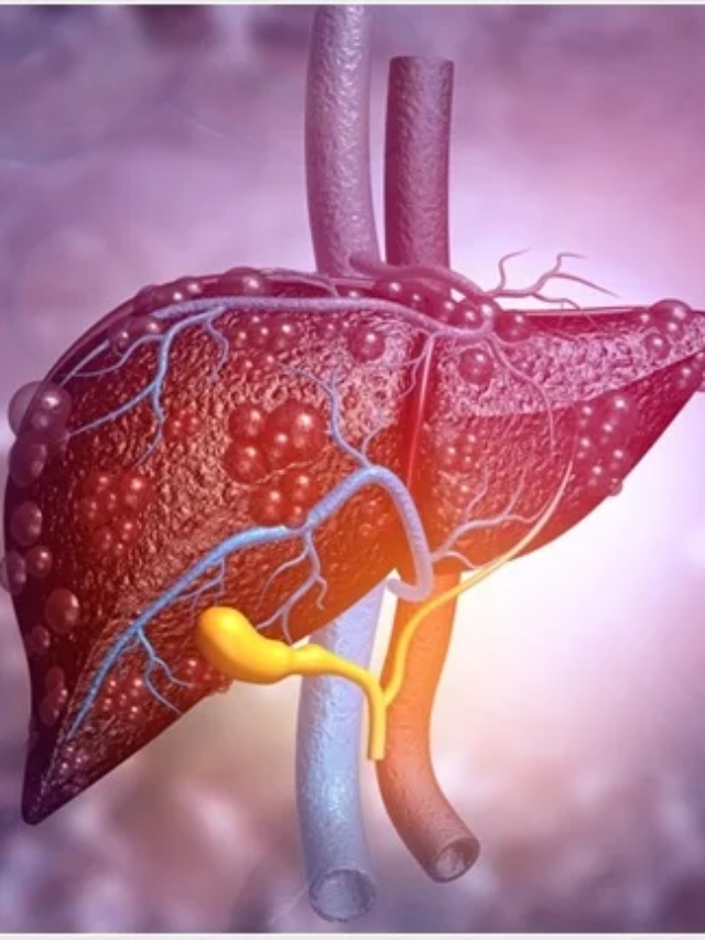 reverse-fatty-liver-with-12-natural-foods