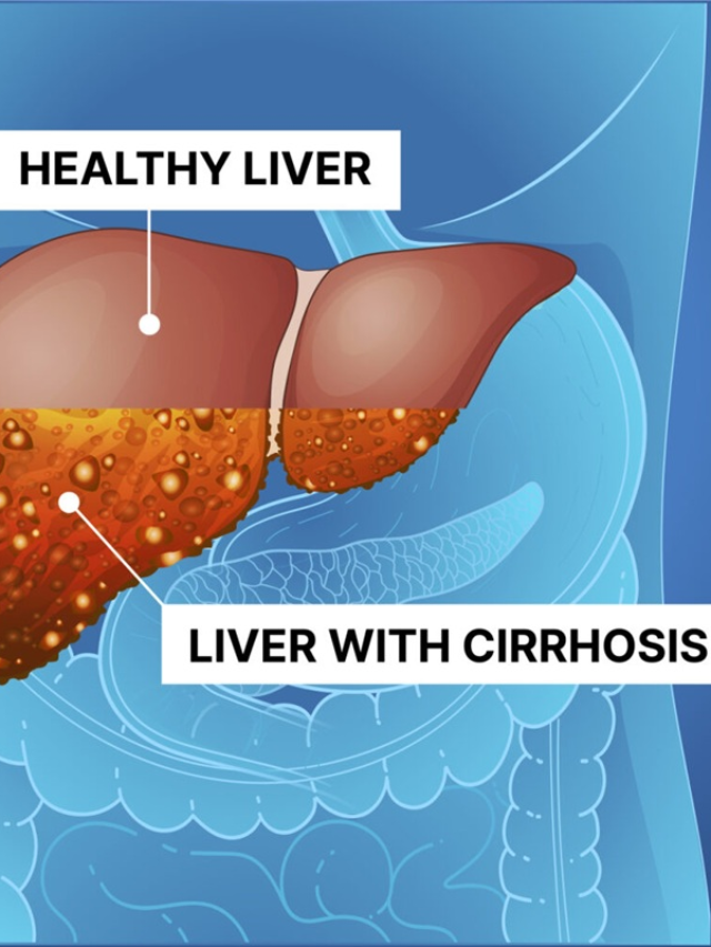 liver-cirrhosis-treatment-supplement-research
