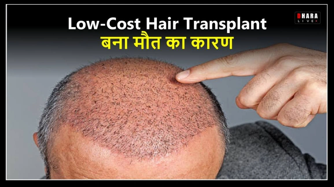 why-is-botched-hair-transplant-becoming-a-health-risk-know-how-viral-cosmetic-surgery-can-become-the-reason-for-permanent-scalp-damage